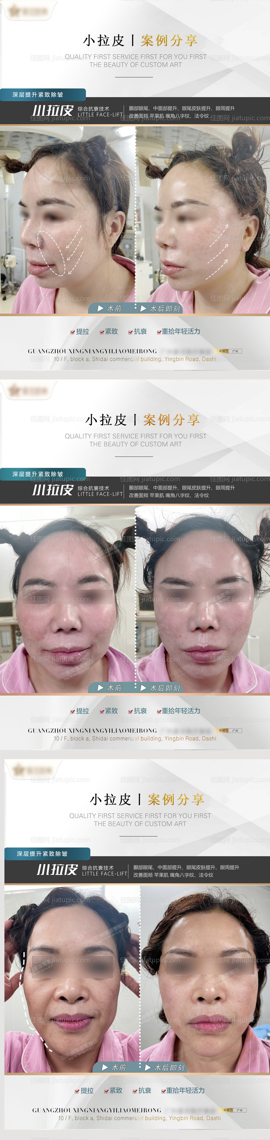 医美小拉皮案例系列海报-源文件